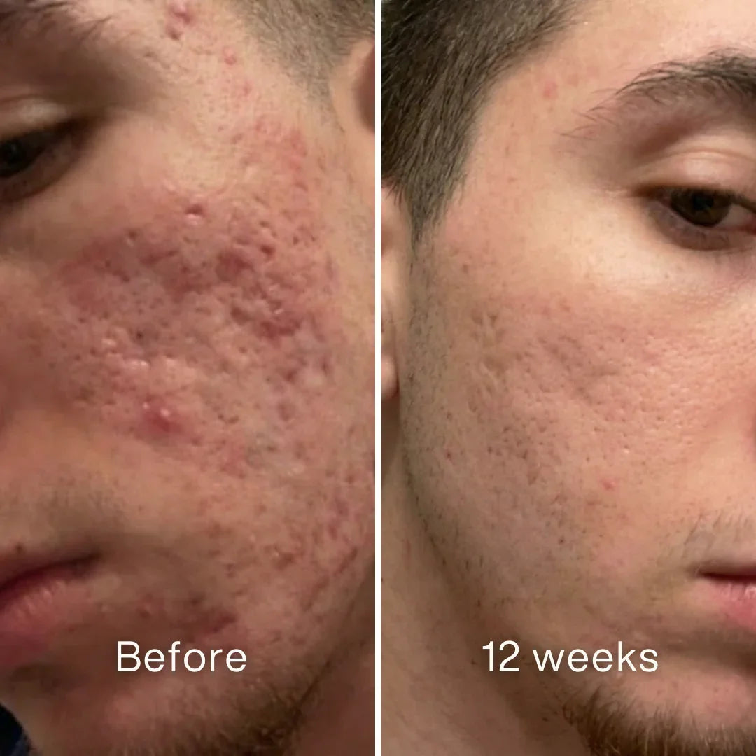 Pluune acne treatment before and after, male face with reduced acne in 12 weeks