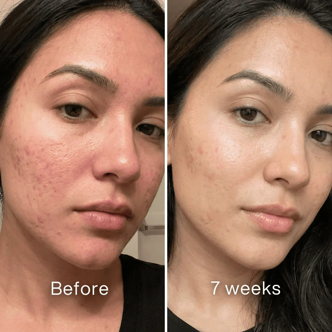 Pluune skincare before and after 7 weeks showing improved skin texture and reduced acne