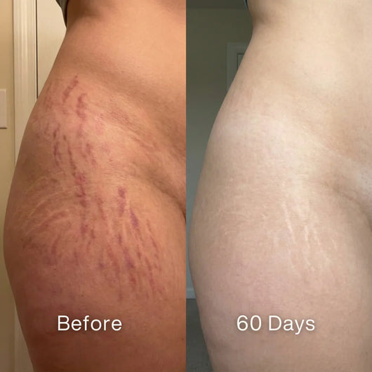 Scar Renewal - Advanced Medical Silicone