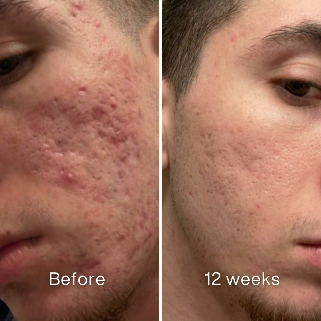 Clinical Acne Scar Remodeling Stick™