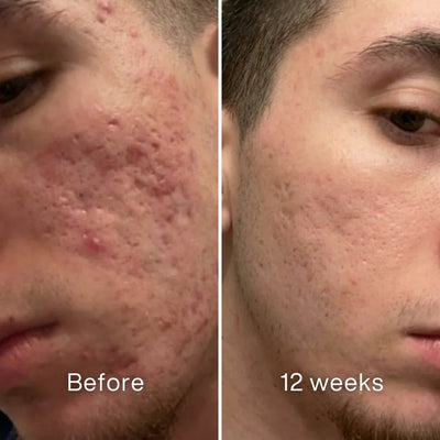 Pluune acne treatment before and after, male face with reduced acne in 12 weeks