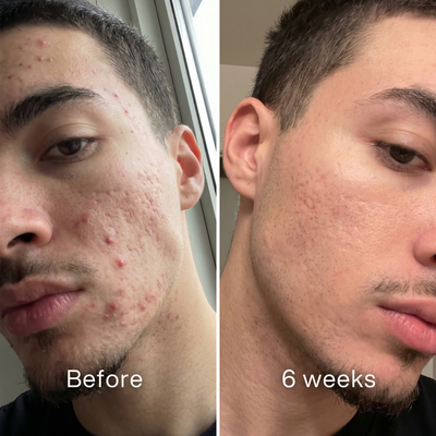 Kill Acne & Redness Stick™