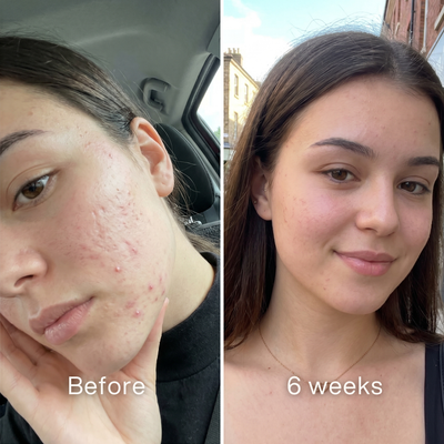 Clinical Acne Scar Repair Stick™.