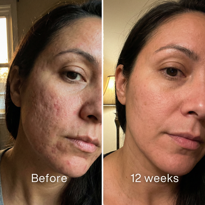 Clinical Acne Scar Repair Stick™.