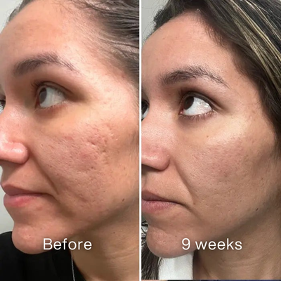 Clinical Acne Scar Repair Stick™.