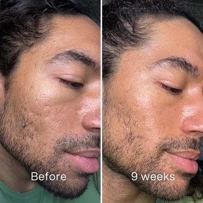 Clinical Acne Scar Repair Stick™.