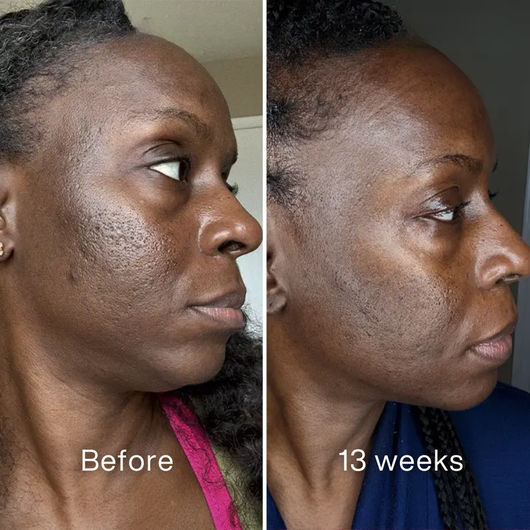 Clinical Acne Scar Repair Stick™.