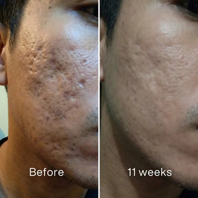 Acne Scar Invisible Repair Barrier™ - Pluune