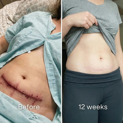Clinical C - Section Scar Remodeling Stick™ - Pluune