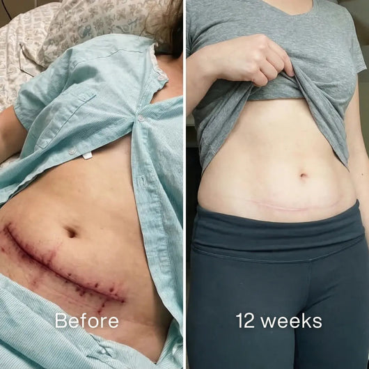 Clinical C - Section Scar Remodeling Stick™ - Pluune