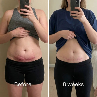 Clinical C - Section Scar Remodeling Stick™ - Pluune