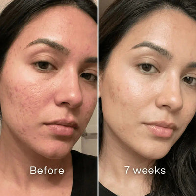 Clinical Scar Recovery System™ - Pluune