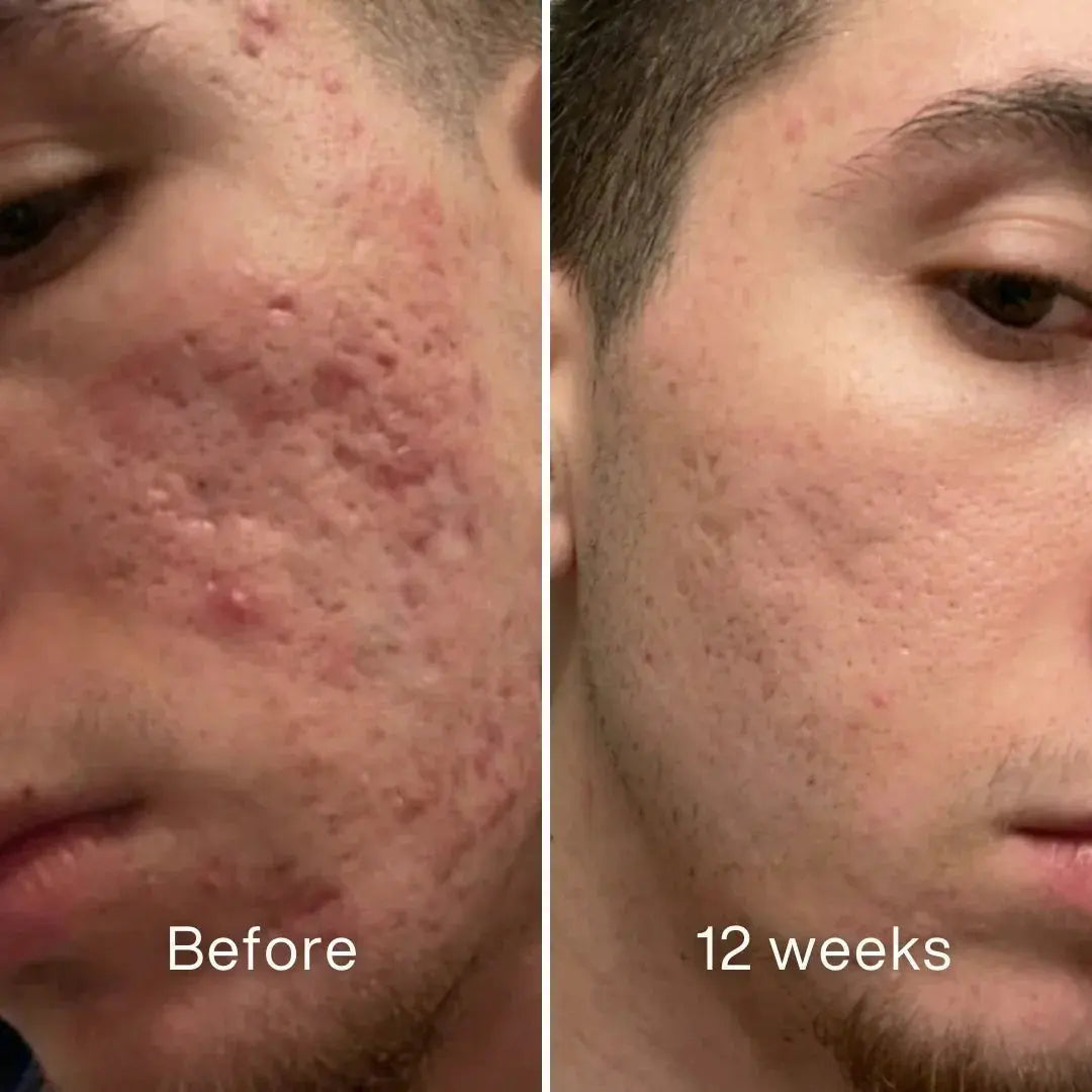 Clinical Scar Recovery System™ - Pluune