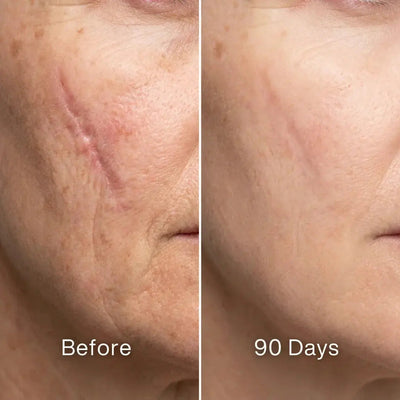 Scar Renewal - Advanced Medical Silicone - Pluune