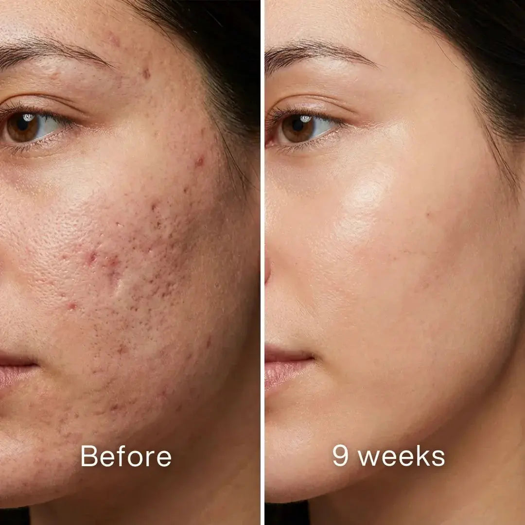 Scar Renewal - Advanced Medical Silicone - Pluune