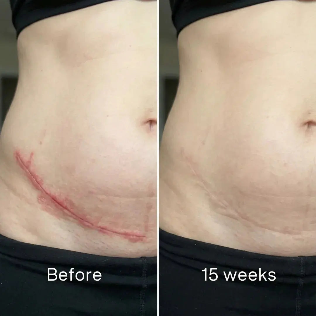 Scar Renewal - Advanced Medical Silicone - Pluune