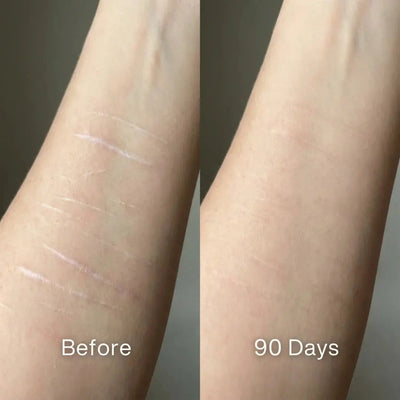 Scar Renewal - Advanced Medical Silicone - Pluune