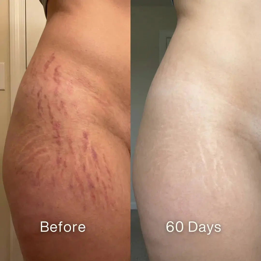Scar Renewal - Advanced Medical Silicone - Pluune
