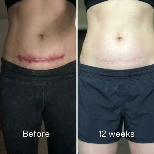 Self - Harm Scar Remodelling Stick™ - Pluune