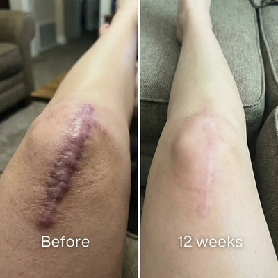 Self - Harm Scar Remodelling Stick™ - Pluune