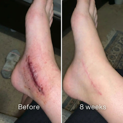 Self - Harm Scar Remodelling Stick™ - Pluune